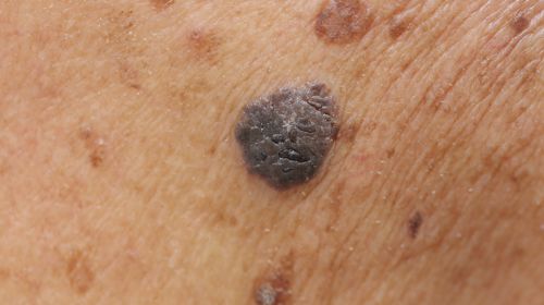 Black skin cancer or birthmark?  These pictures will help you recognize it!