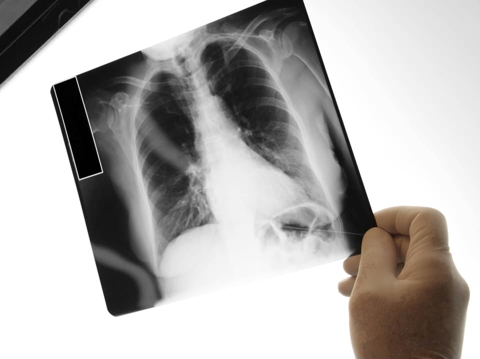 A hand holds an x-ray showing a chest