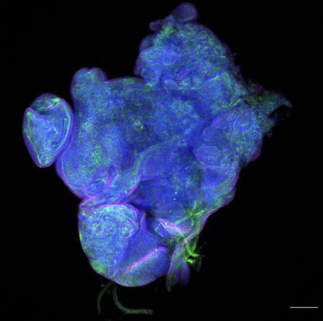 A tumor, a cluster of abnormal cells, caused by an epigenetic disruption.  The DNA, colored blue, is no different from that of a healthy cell. 